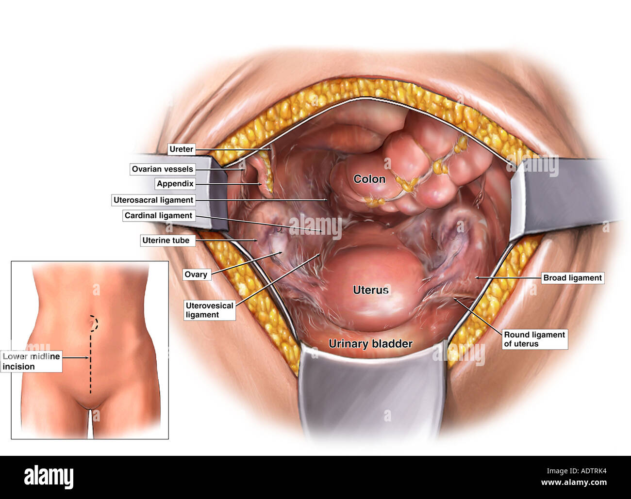Surgical Exposure for Hysterectomy Stock Photo