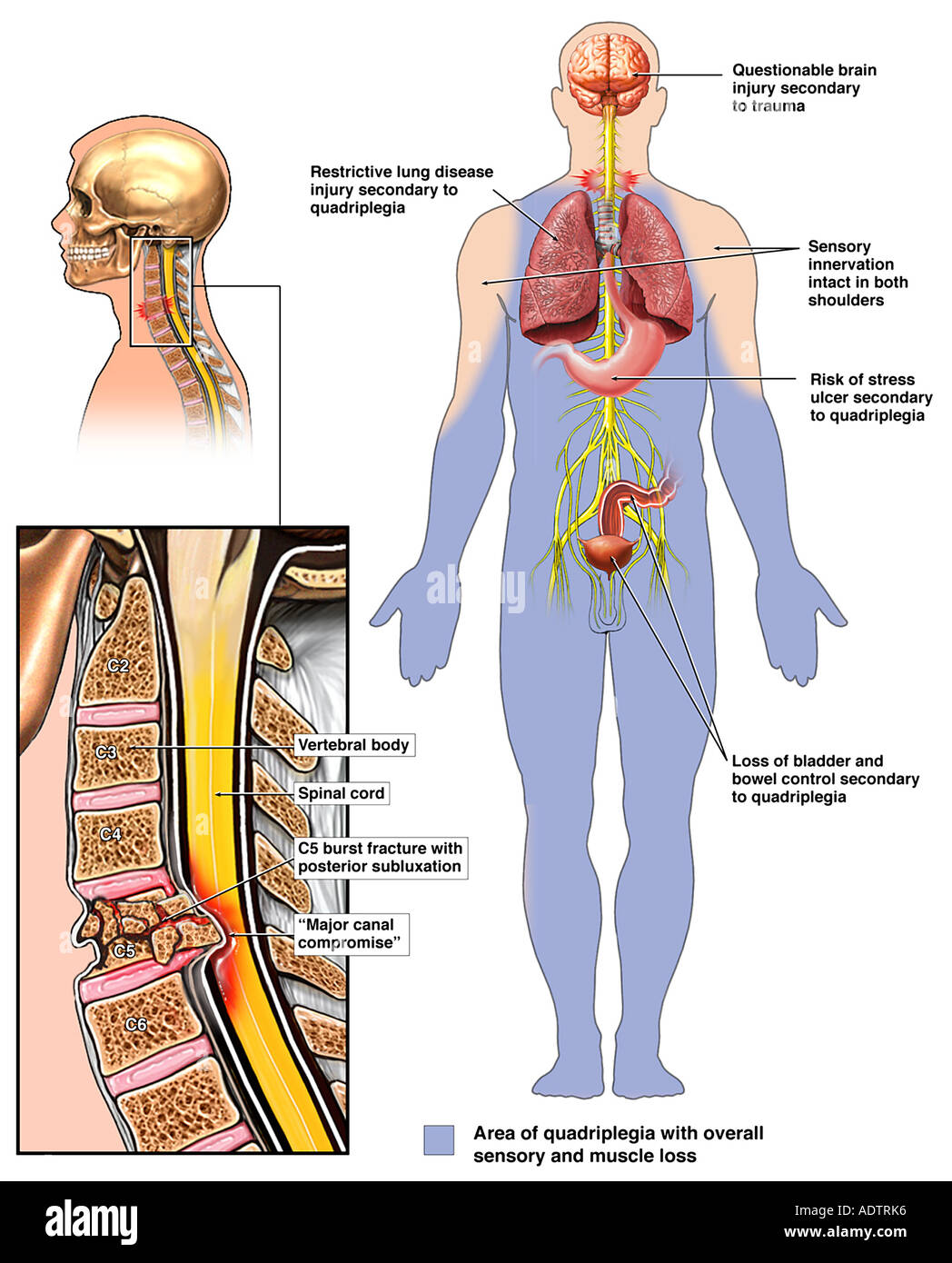 C5 Fracture Subluxation with Quadriplegia Stock Photo Alamy