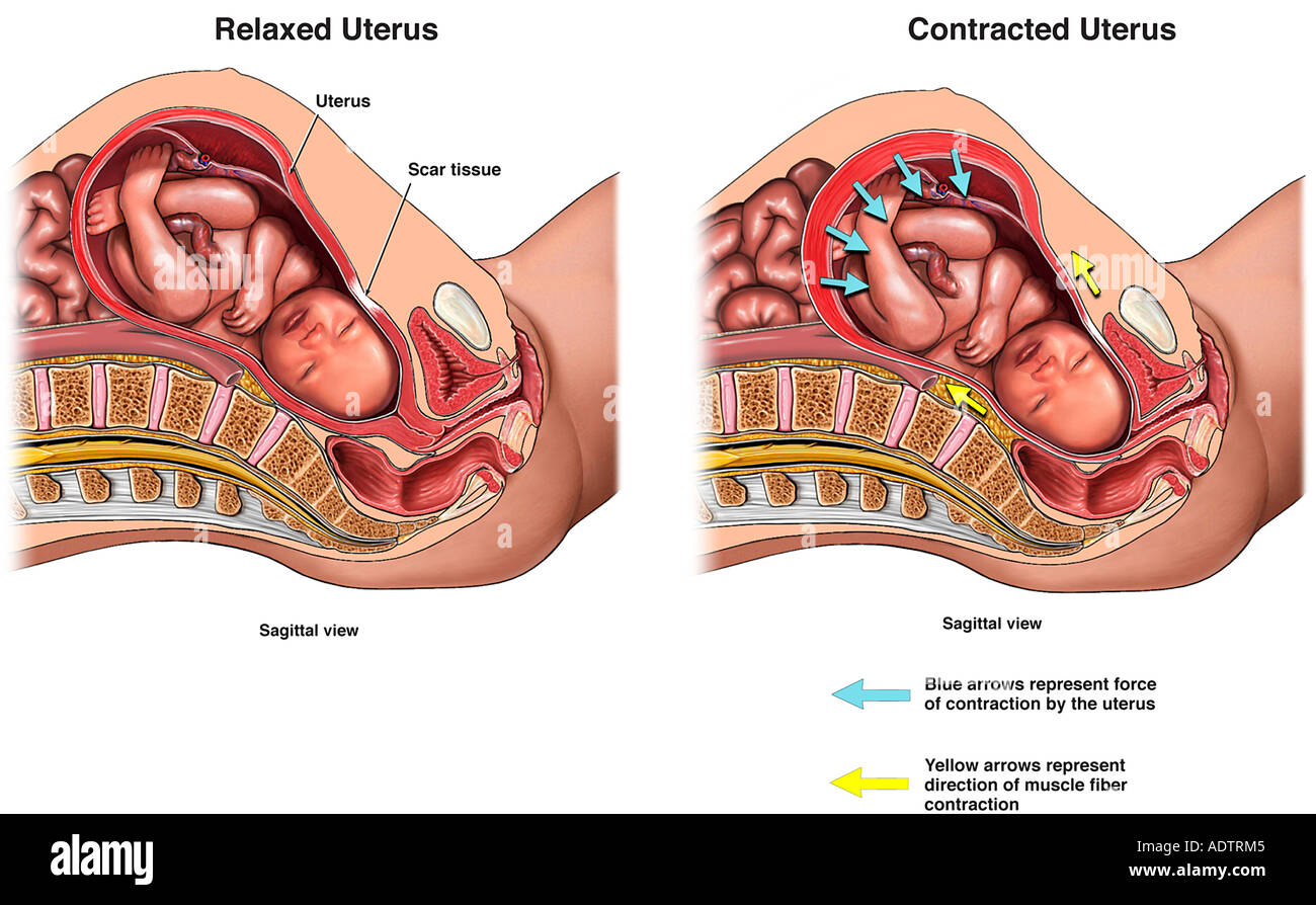 uterine-rupture-during-labor-stock-photo-7710084-alamy