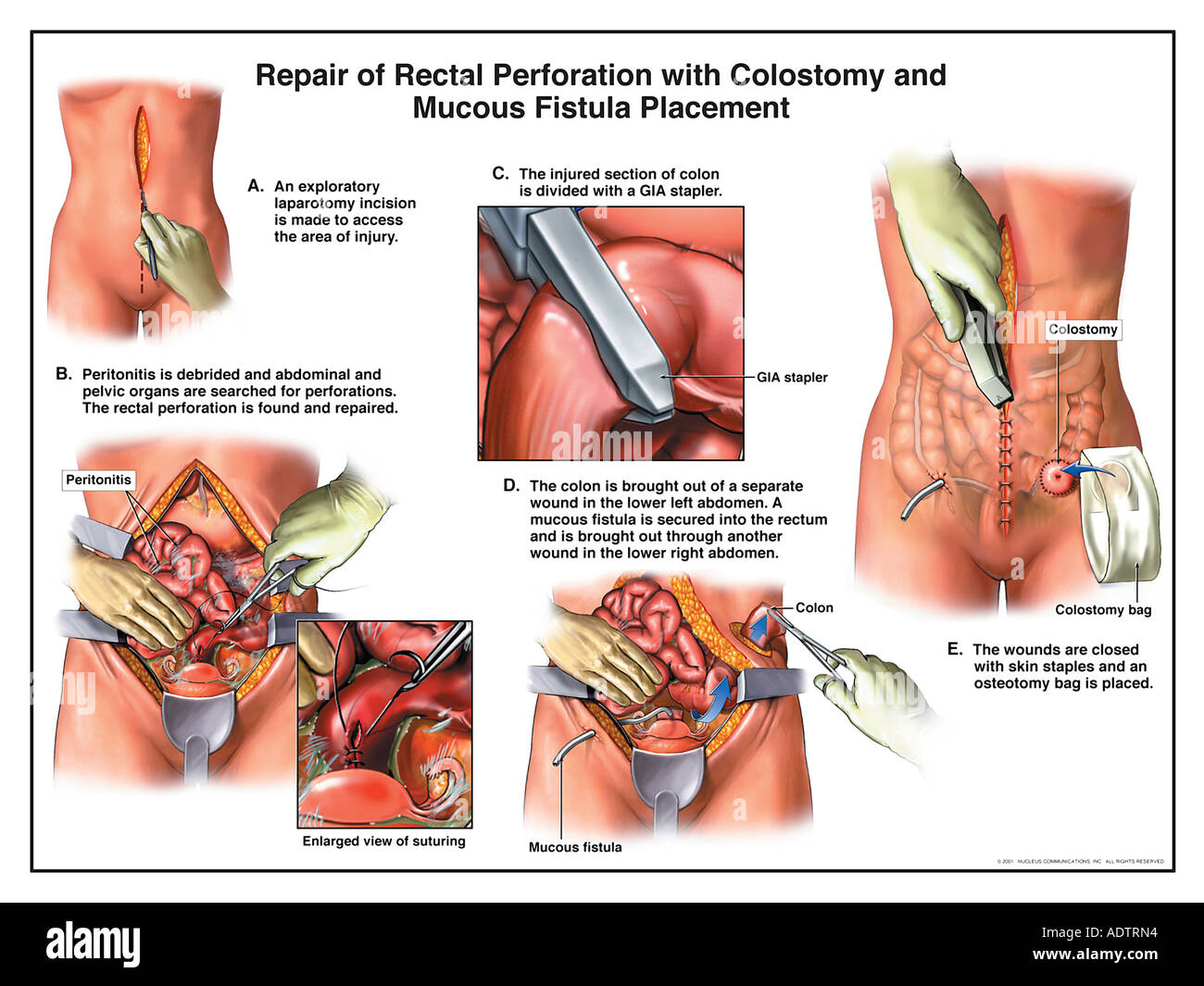 Repair of Rectal Perforation with Colostomy and Mucous Fistula Placement Stock Photo