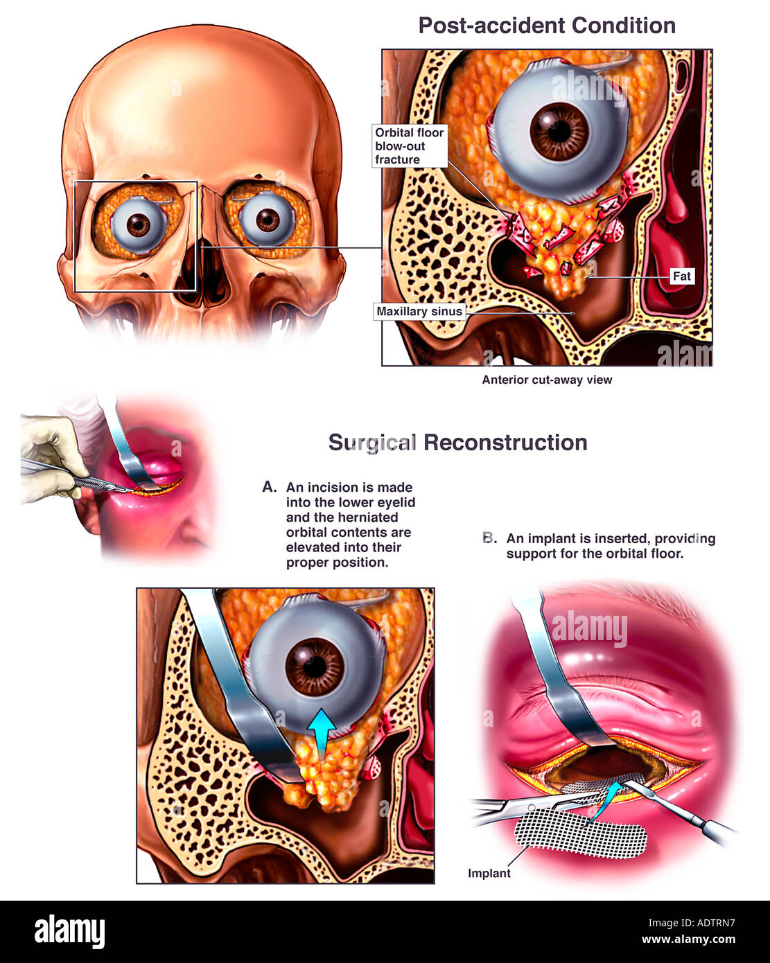 Post Accident Orbital Fracture With Surgical Reconstruction Stock