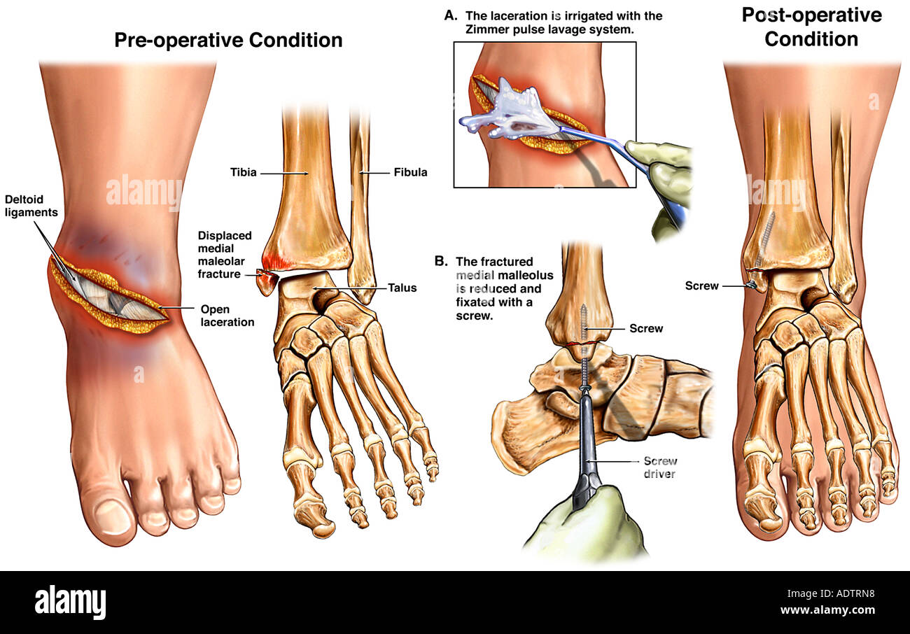 Distal fibula fracture hires stock photography and images Alamy