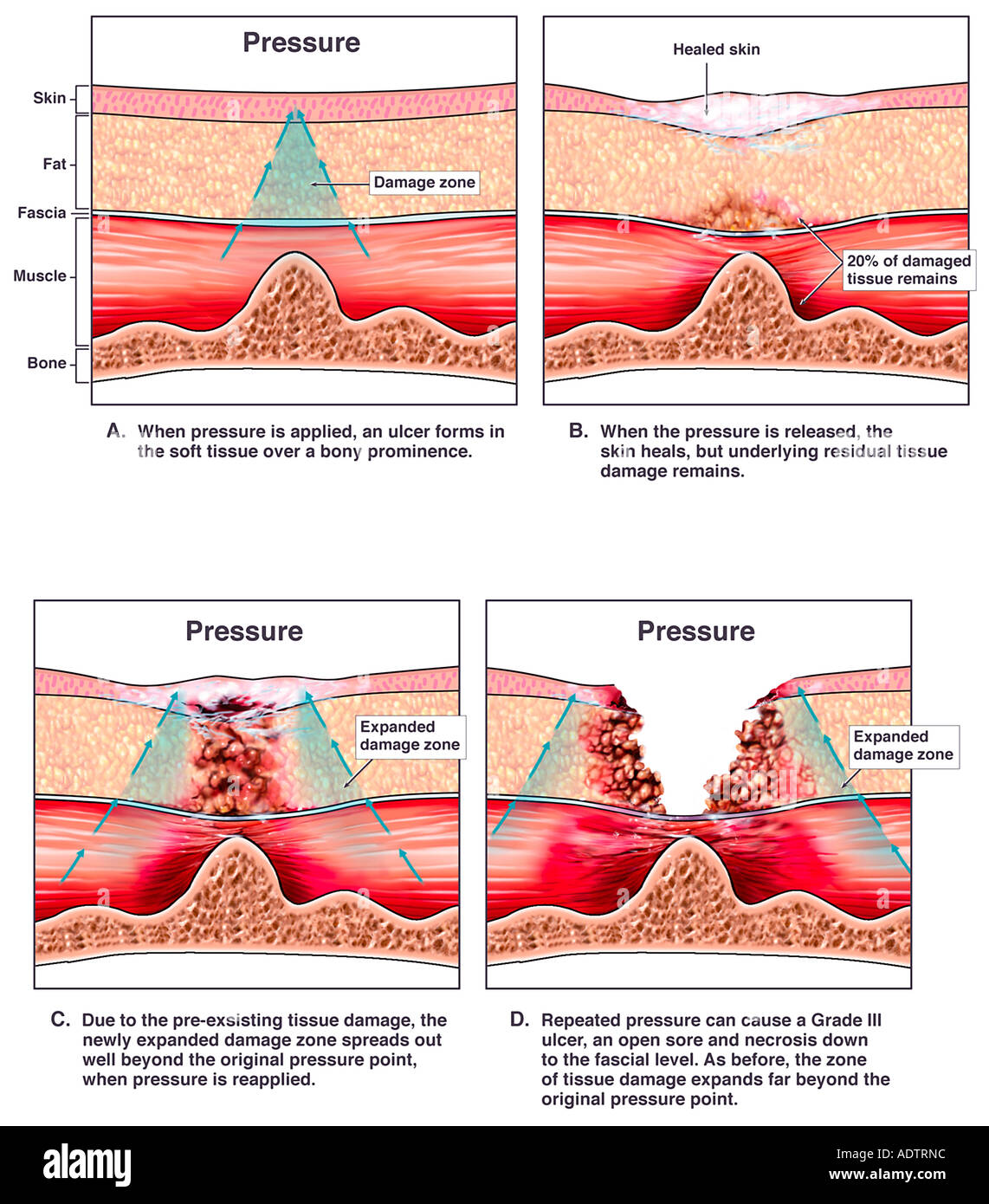 Stages Of Pressure Ulcer Pressure Injury Stages What They Are And Stages Of Pressure Ulcer Pressure Injury Stages What They Are And