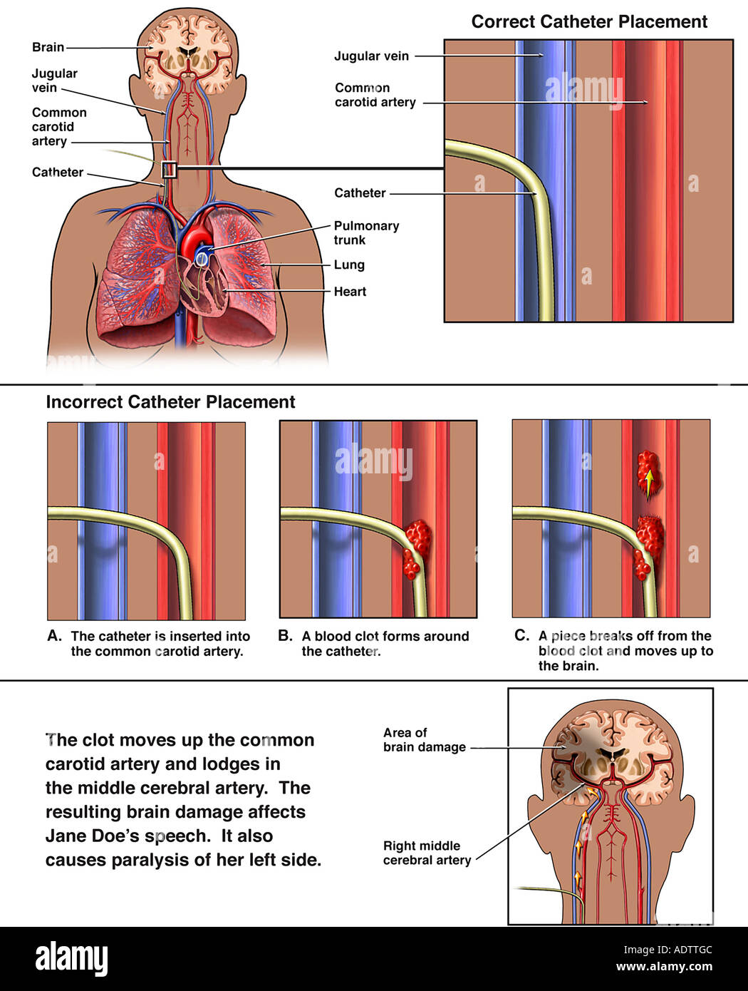 Catheterization - Incorrect Placement of Swan-Ganz Catheter with Subsequent Embolism and Stroke Stock Photo