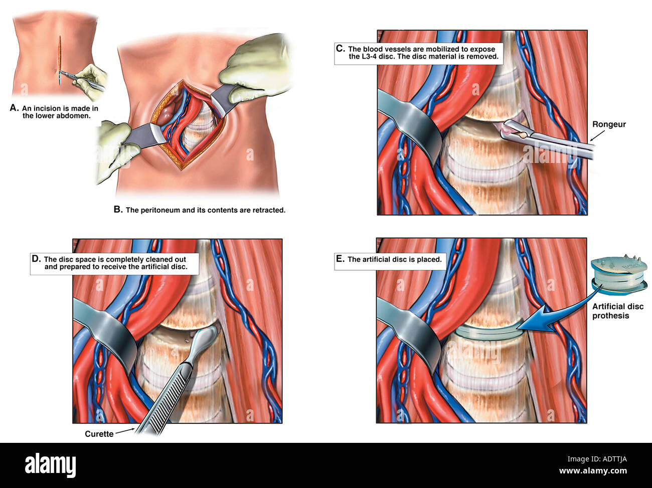 Anterior Lumbar Discectomy with Artificial Disc Replacement Stock Photo
