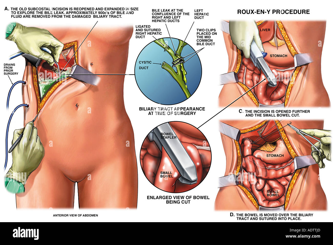Roux-en-Y Gastric Bypass Surgery to Correct Biliary Tract Injury Stock Photo