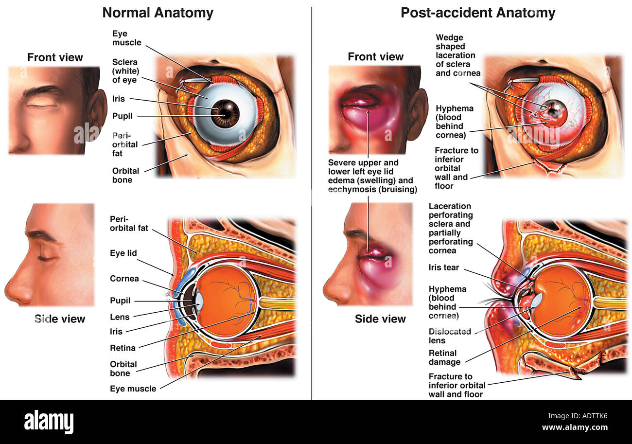 Intact Eye Orbital fracture hi-res stock photography and images - Alamy