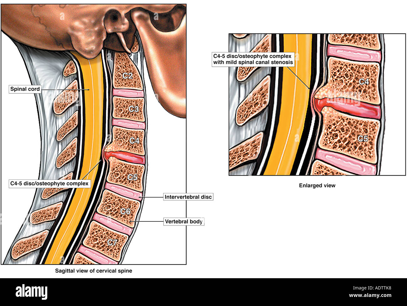 c5 c6 spine