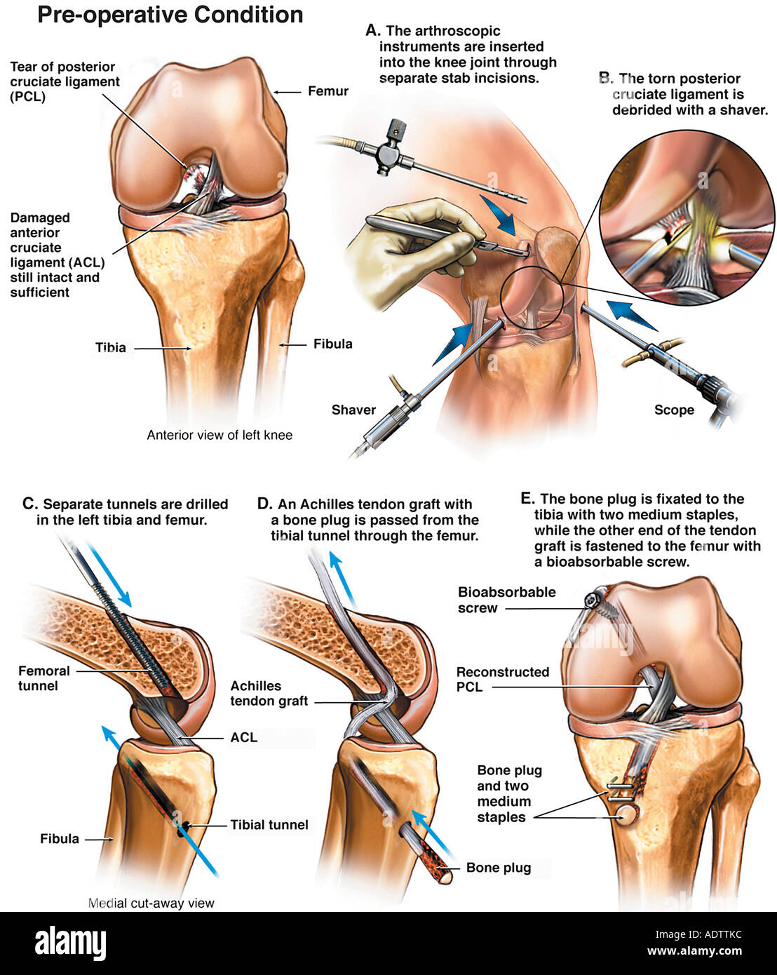 left-knee-injuries-with-posterior-cruciate-ligament-reconstruction