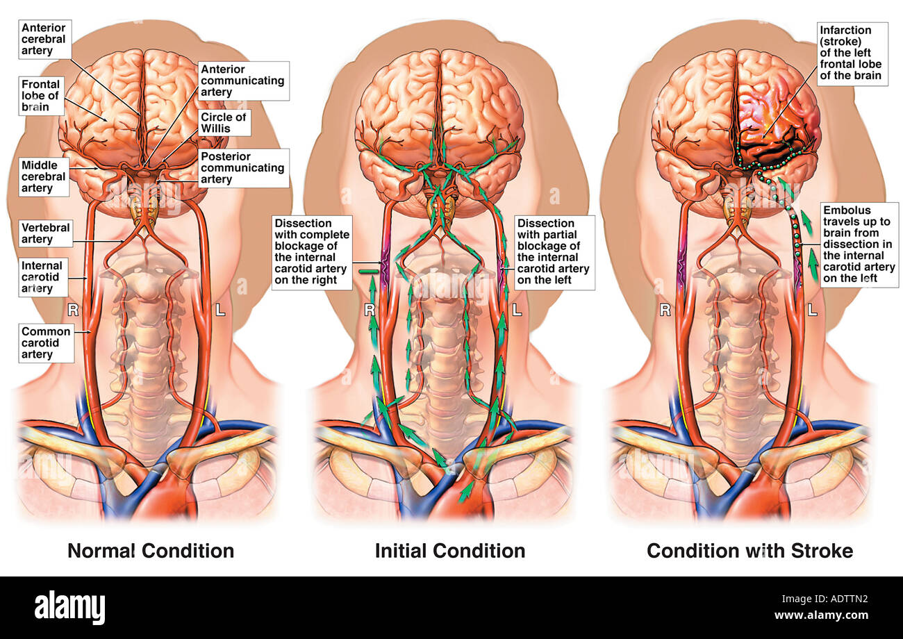 Interruption of the Cervical Vasculature with Infarction of the Left Frontal Lobe of the Brain Stock Photo