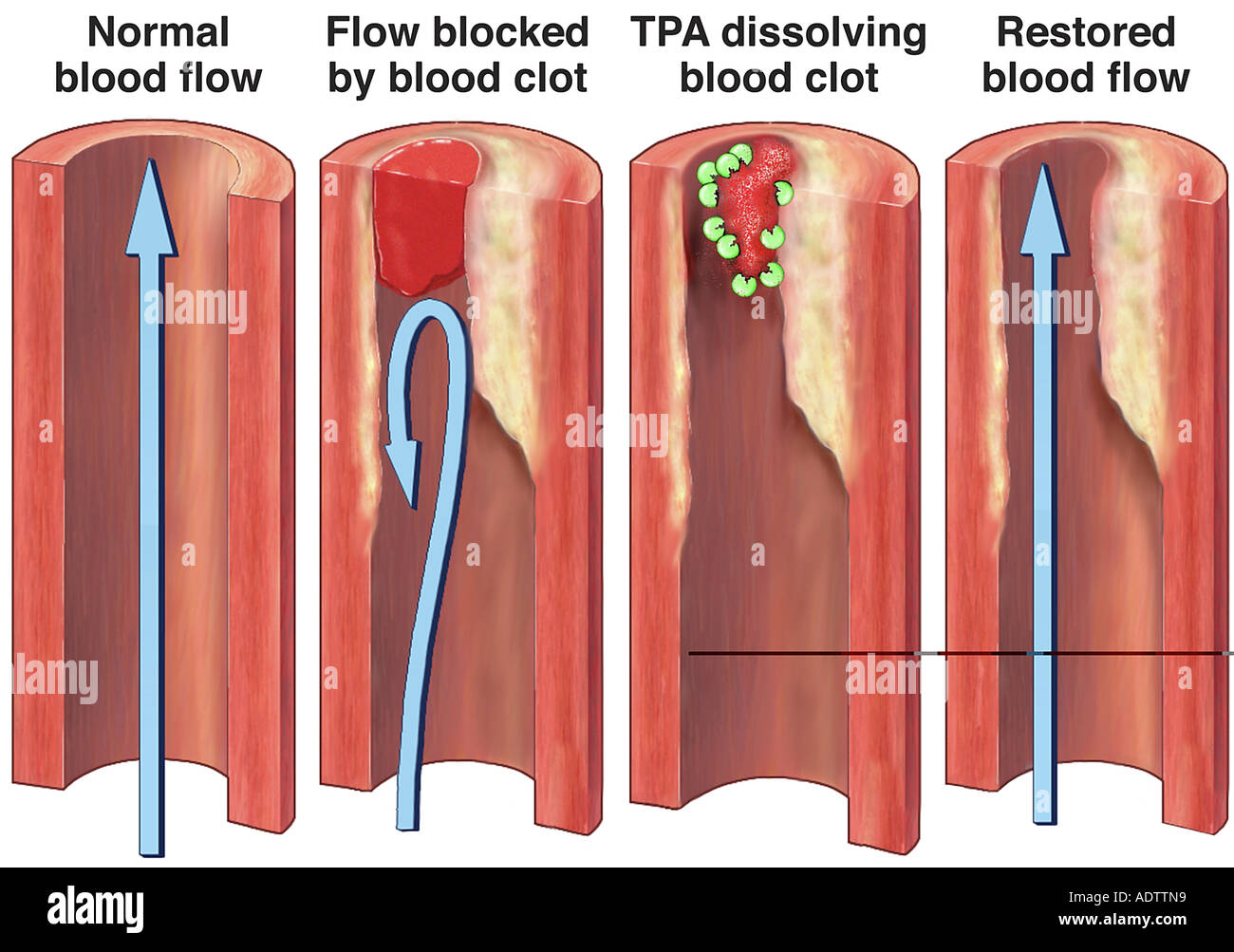 TPA Dissolving Blood Clot Stock Photo