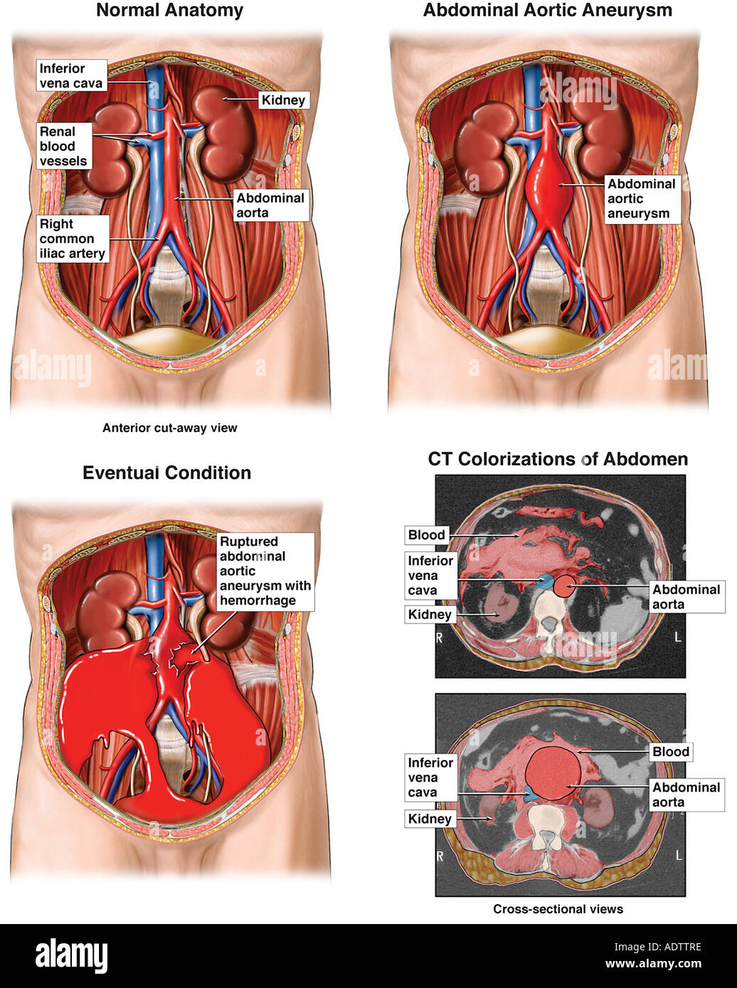 what causes an aortic aneurysm to rupture