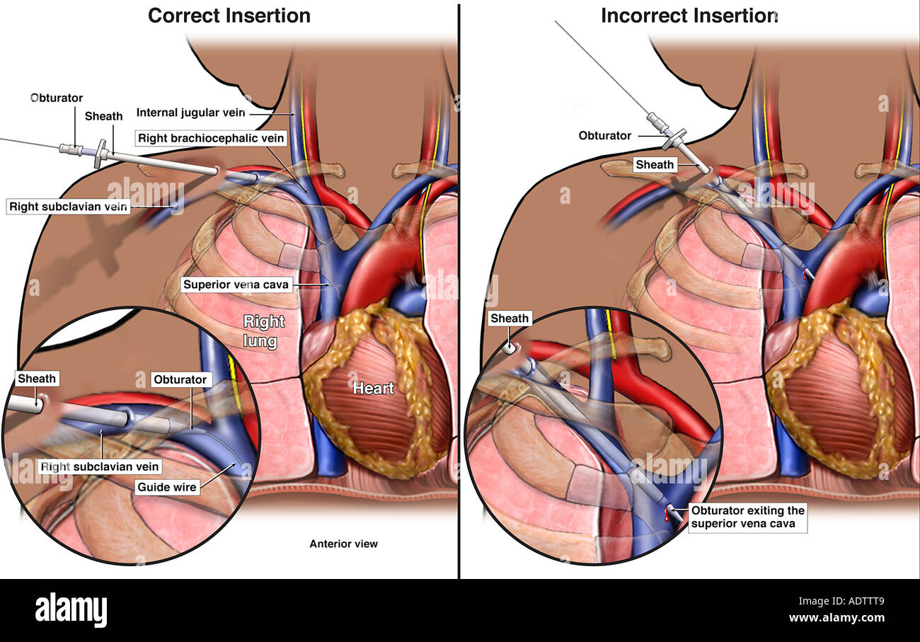 Subclavian Vein High Resolution Stock Photography And Images Alamy