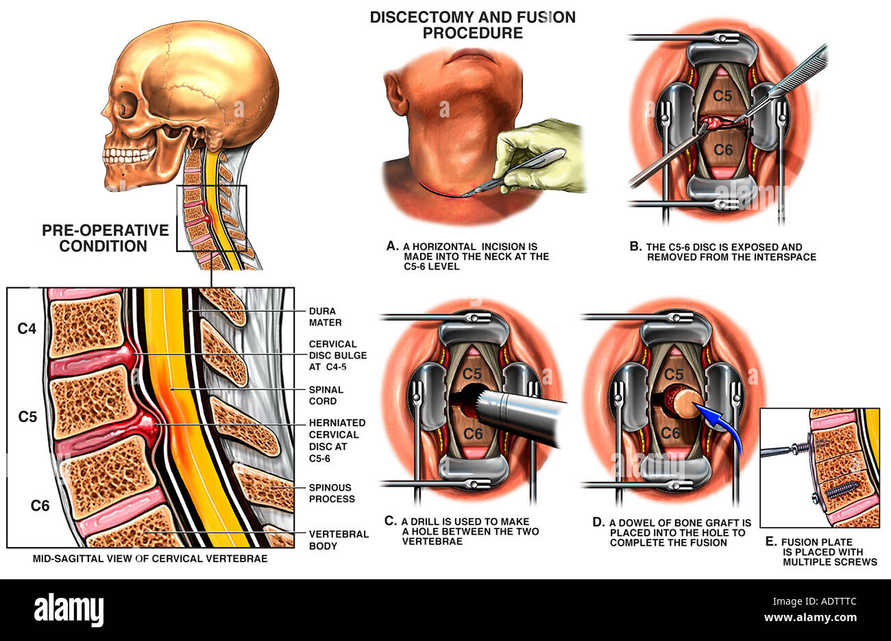 Spinal hernia treatment Spinal hernia treatment