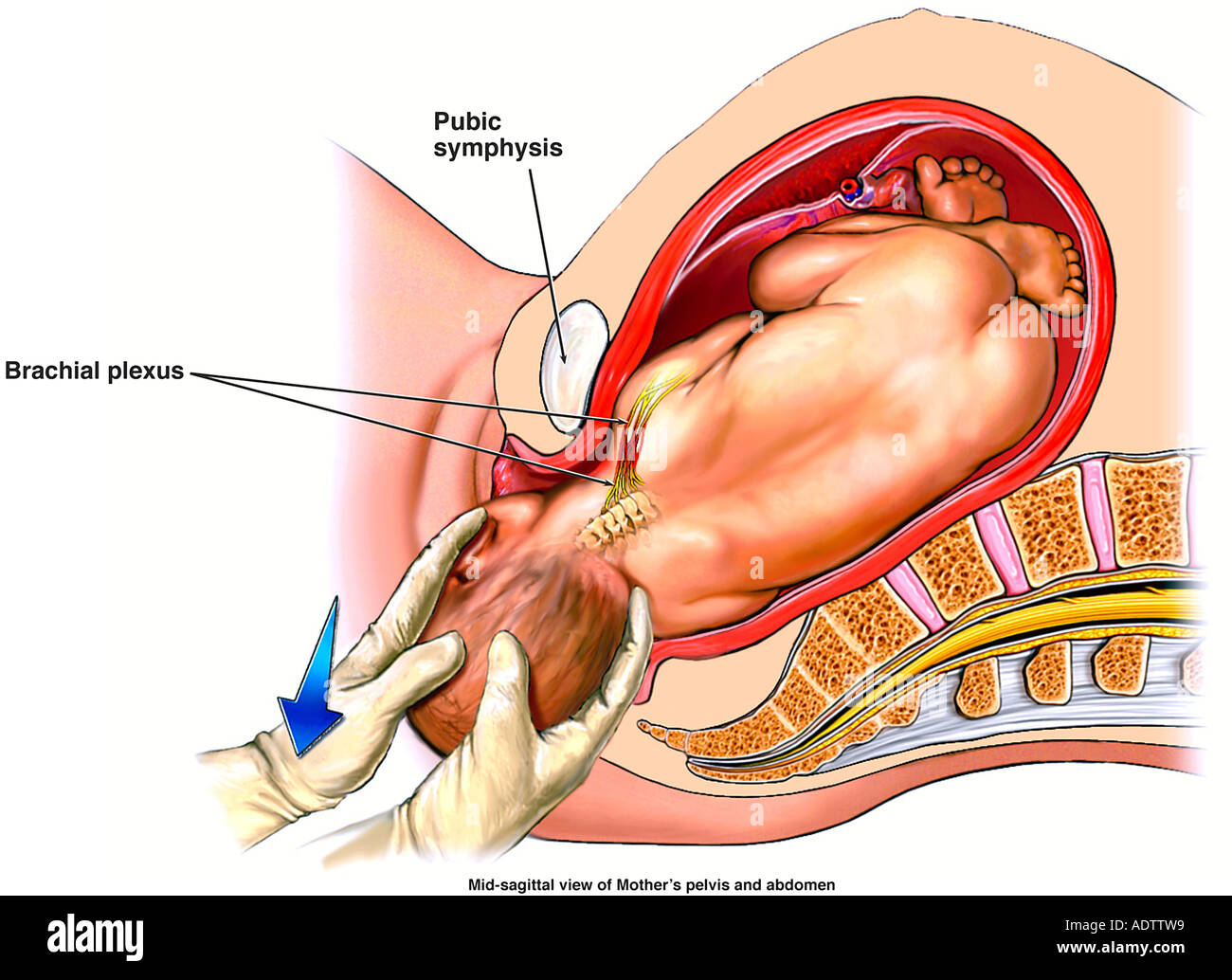 Mechanism of Shoulder Dystocia Stock Photo
