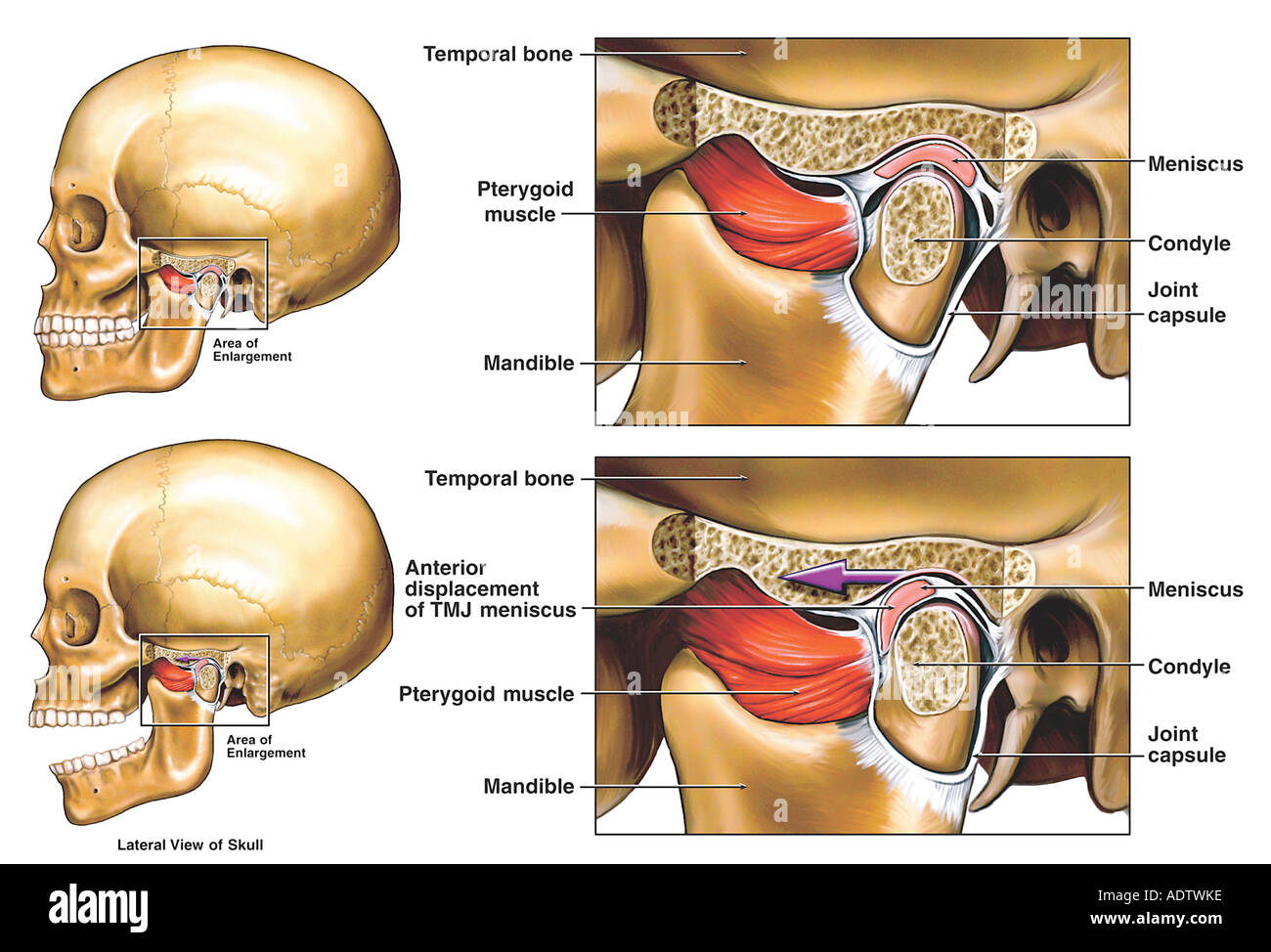 Anterior Displacement of the Left Temporomandibular Joint (TMJ) Stock Photo