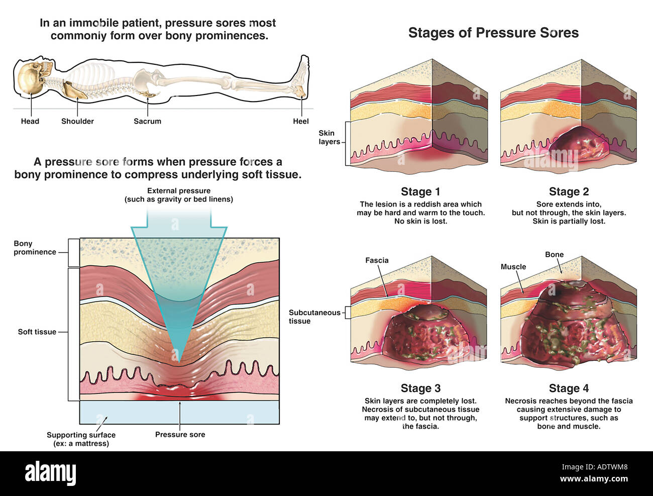 Bedsores hires stock photography and images Alamy