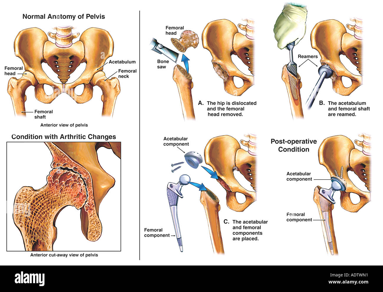 Hip Replacement