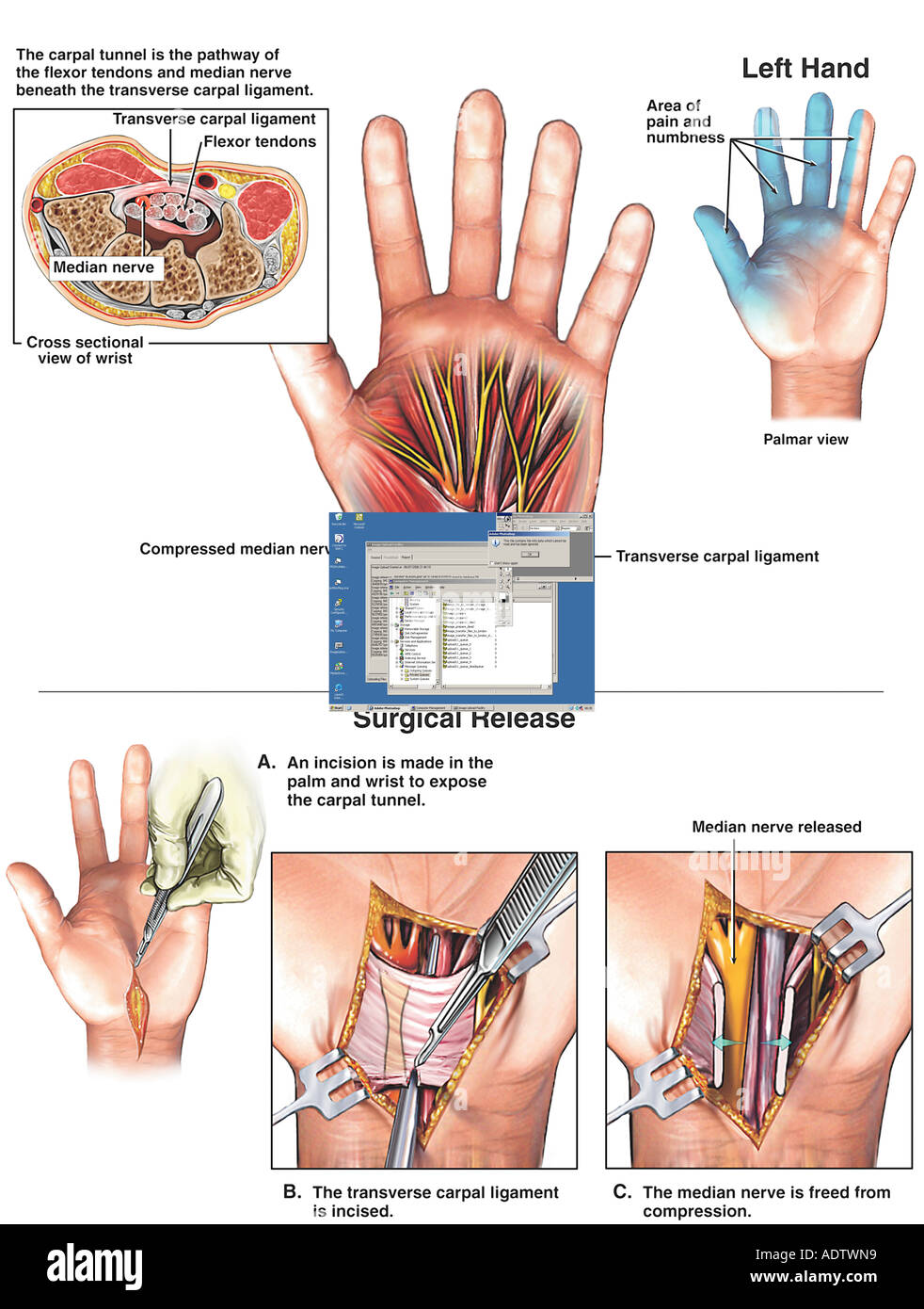 Carpal Tunnel Release Left Hi res Stock Photography And Images Alamy