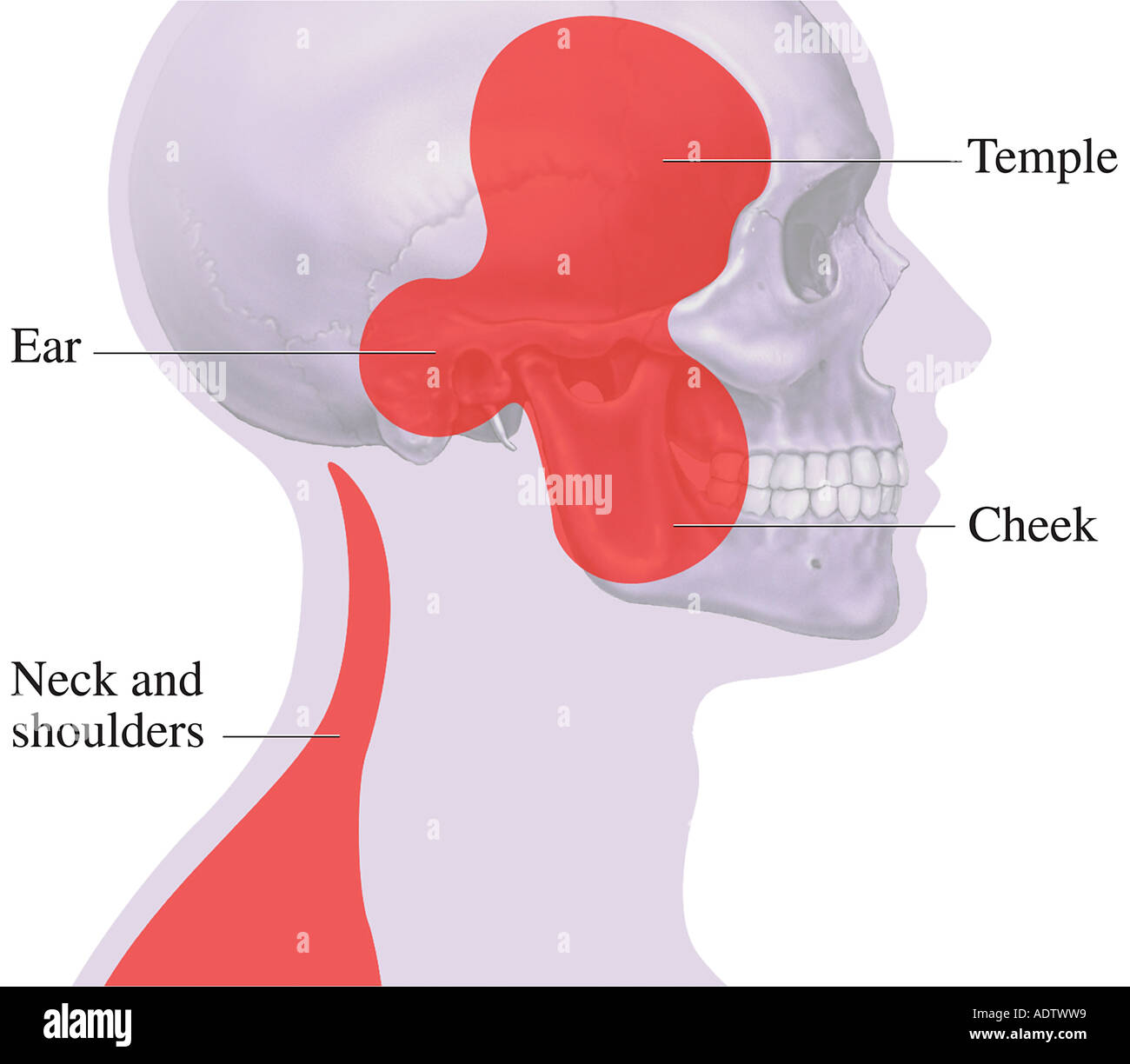 TMJ: Areas of Pain Stock Photo
