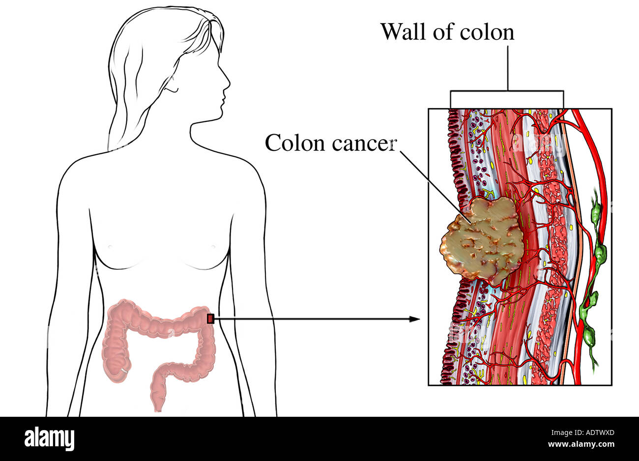 Abnormal Colon Hi res Stock Photography And Images Alamy