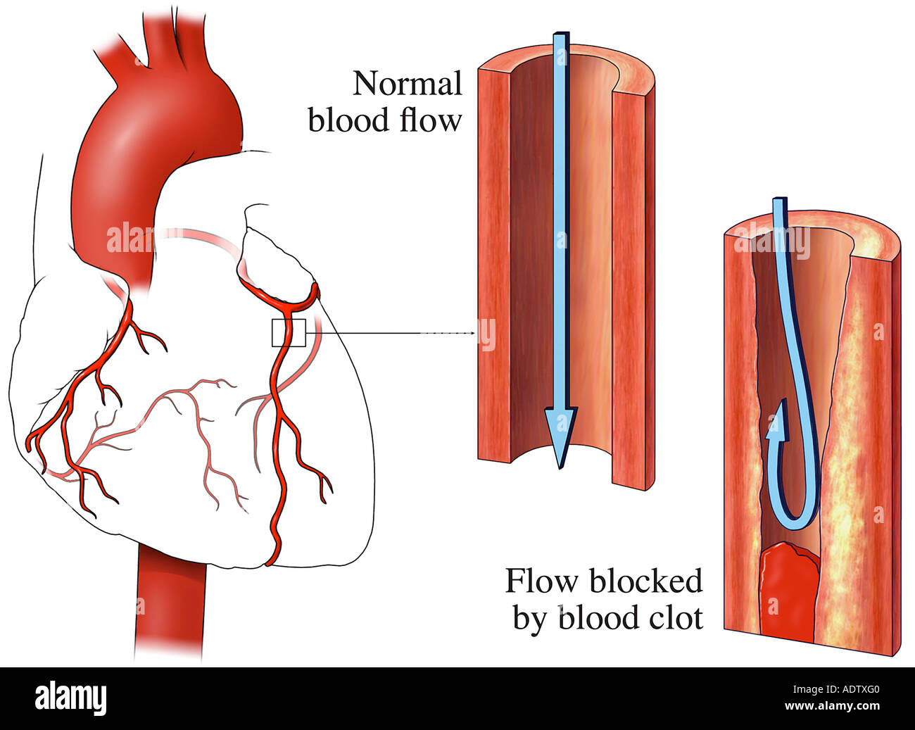 Сердечный тромбоз. Тромбоз артерий сердца. Тромбоз коронарных сосудов.