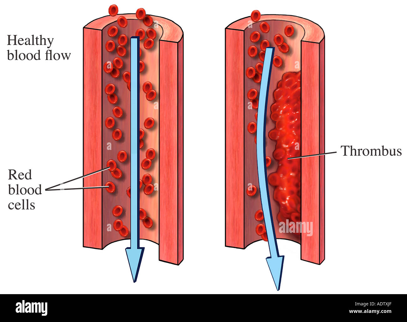 Размеры тромбов. Тромбоз кровеносных сосудов.