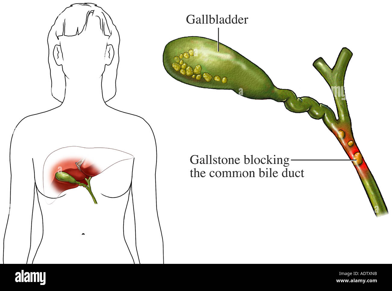 Choledocholithiasis Risk Gallstones High Resolution Stock Photography and Images - Alamy