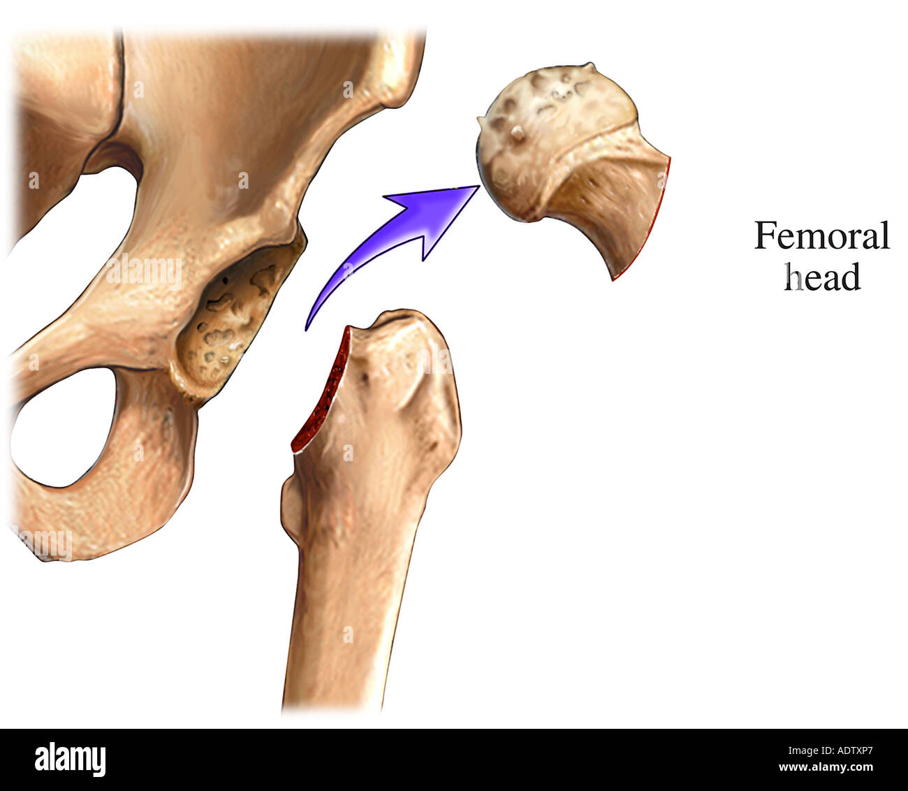 This medical exhibit illustrates the removal of the femoral head Stock Photo