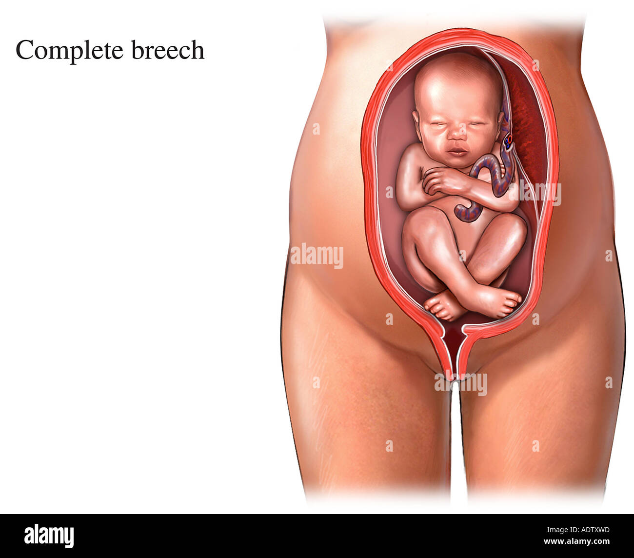 Birthing Positions Complete Breech Stock Photo