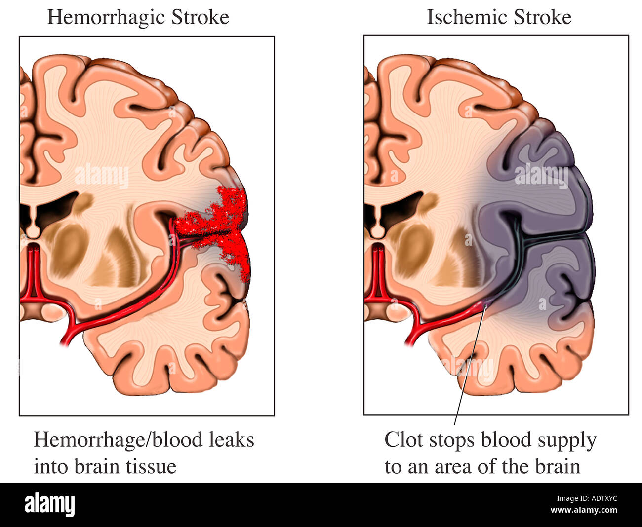 Ischemic Stroke Animation