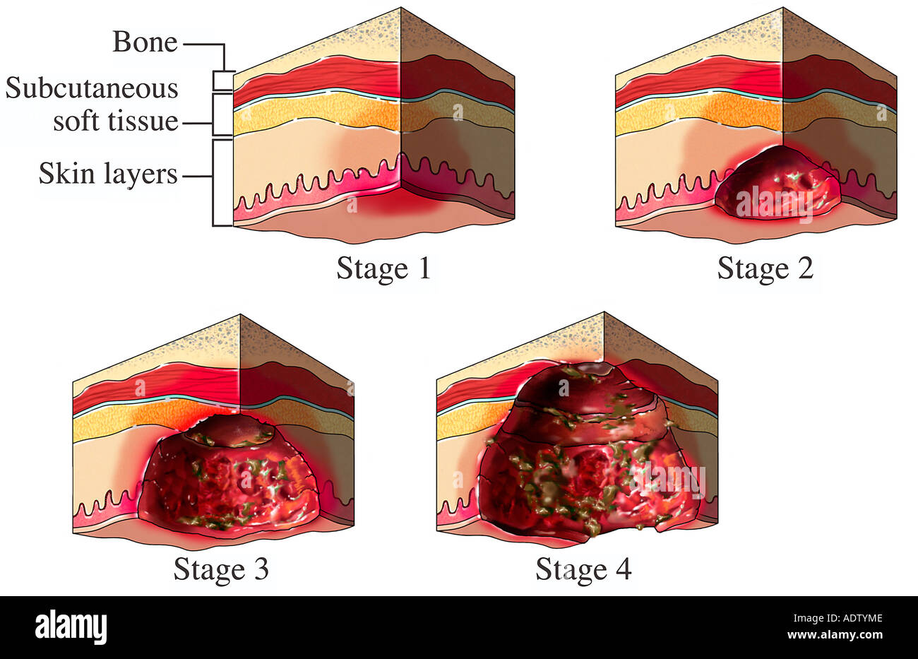 Pressure sores hires stock photography and images Alamy
