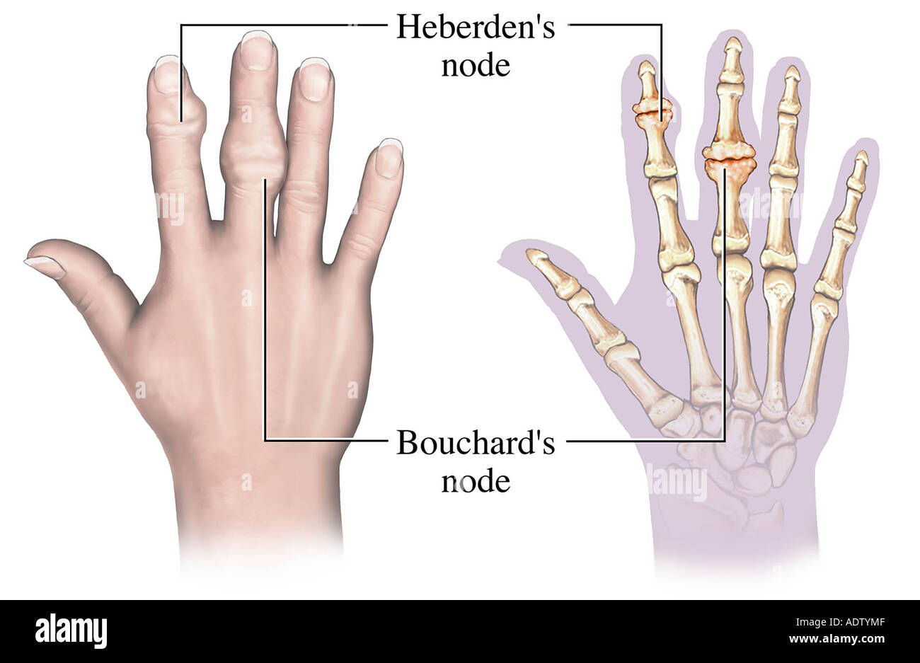 Nodulo De Heberden E Bouchard LIBRAIN