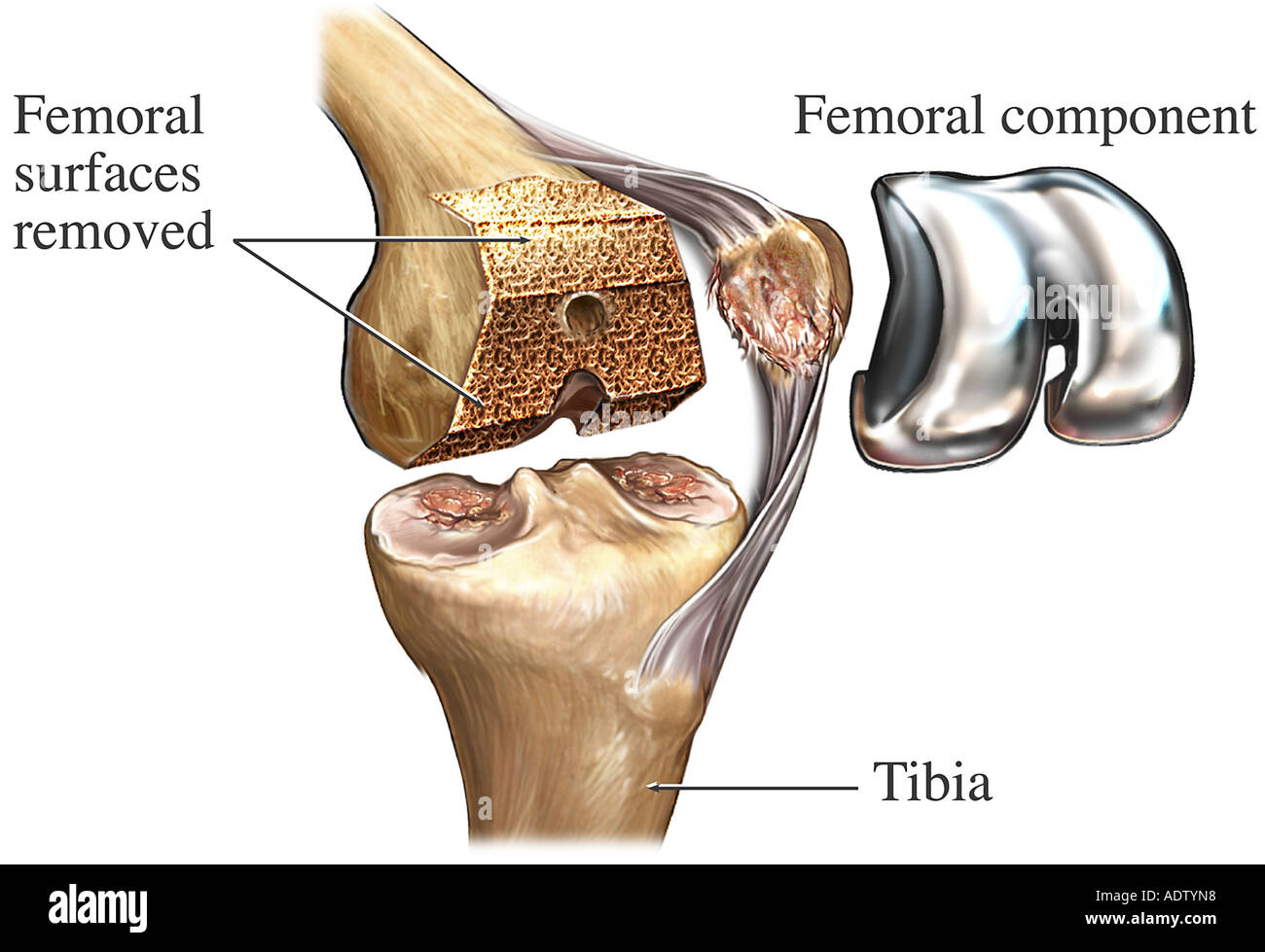 Total Knee Joint Replacement Surgery Stock Photo Alamy