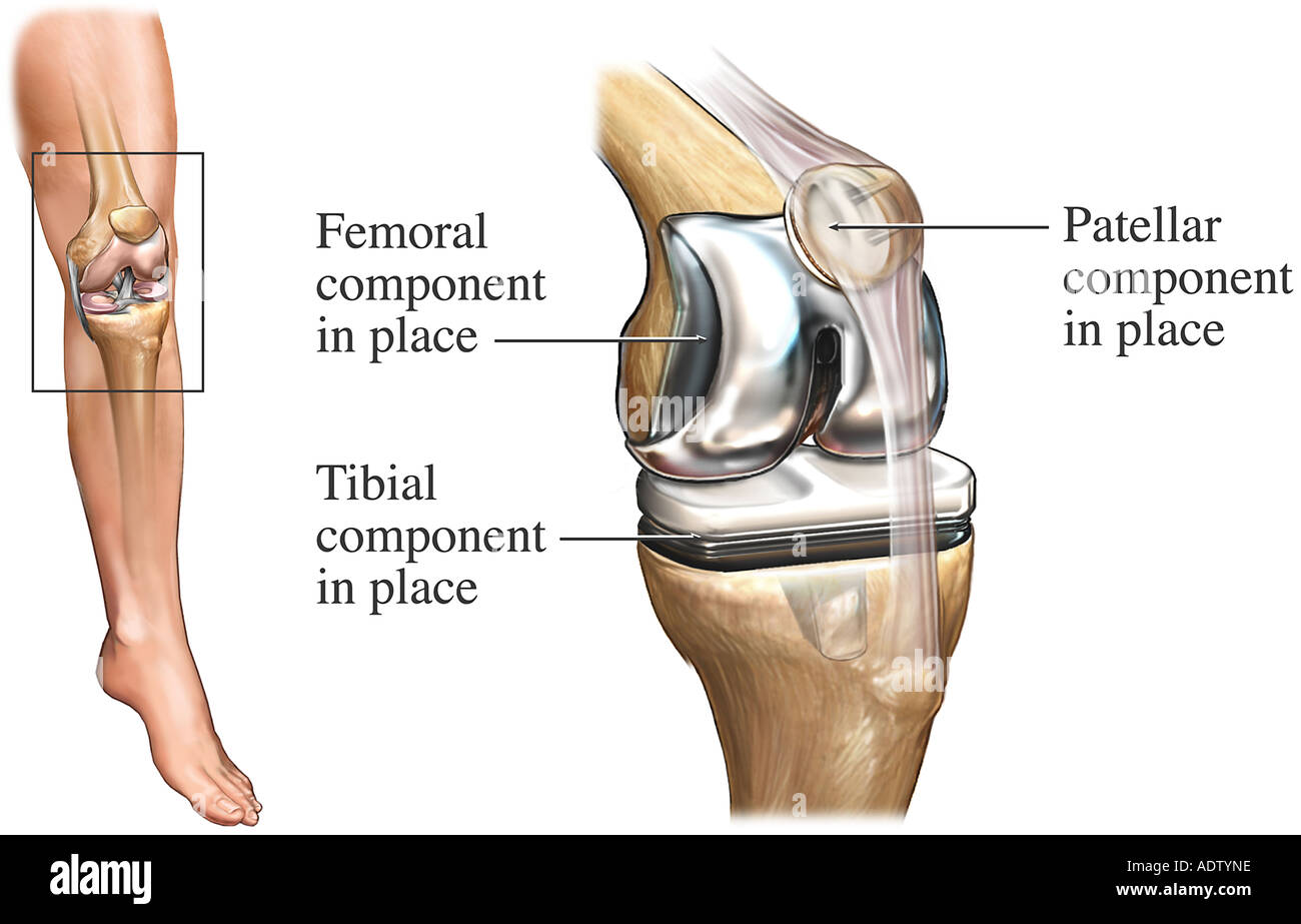 Total Knee Replacement Stock Photo