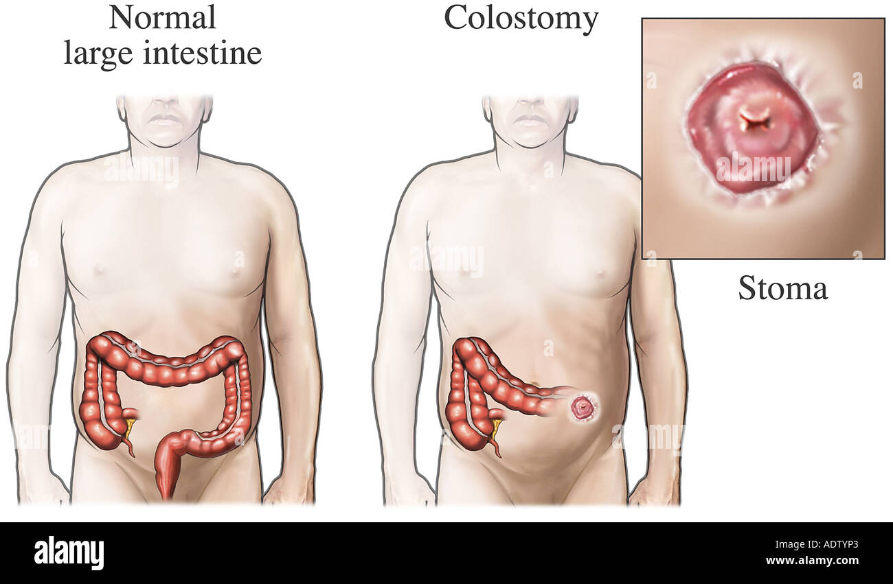 Colostomy hi-res stock photography and images - Alamy