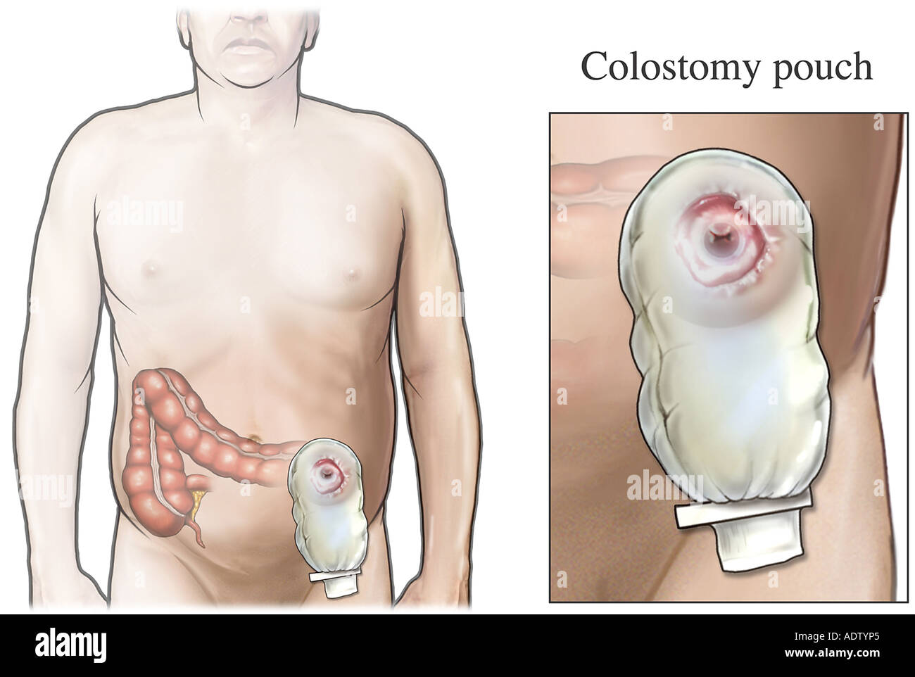 Colostomy Pouch Stock Photo