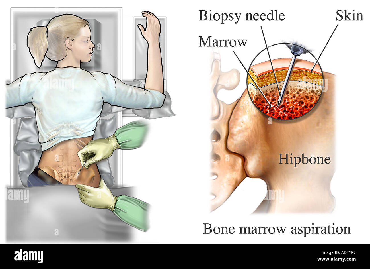трансплантация костного мозга. как сдают костный мозг. как сдают костный мозг. как сдают костный мозг. донерство костного могза.