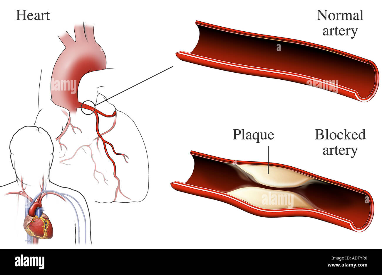 Normal vs. Blocked Artery Stock Photo 7710895 Alamy