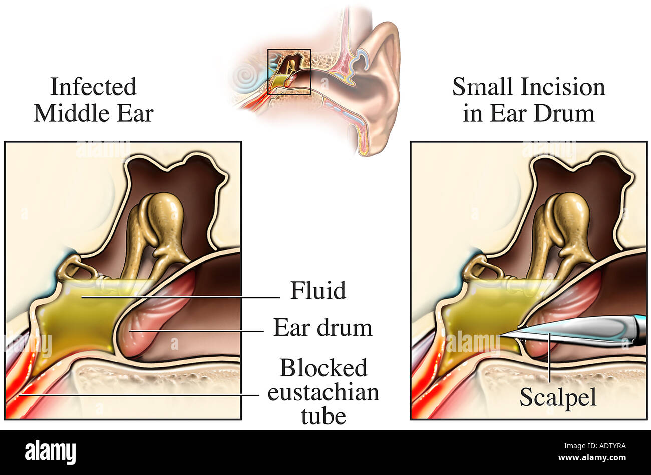 How to drain inner ear fluid