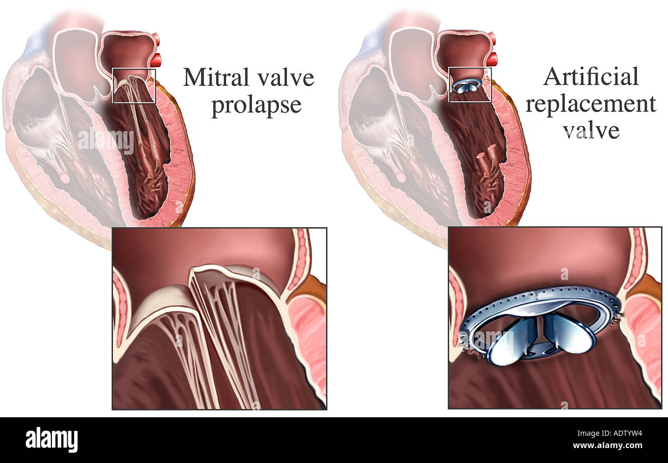 Как клапан делает операция. Симптомы пролапса митрального клапана 1. Пролапс сердца 1 степени. Что такое пролапс митрального клапана сердца 1 степени. Пролапс нейтрального клапана сердца 1 степени.