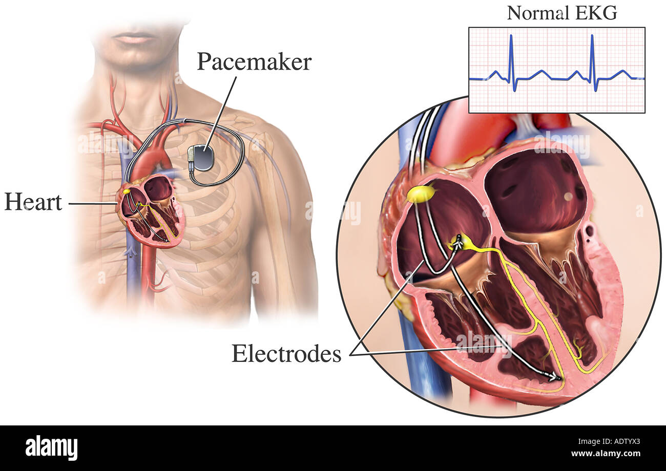 Сколько живут с кардиостимулятором. Операция кардиостимулятор сердца. Электрокардиостимулятор имплантируемый.
