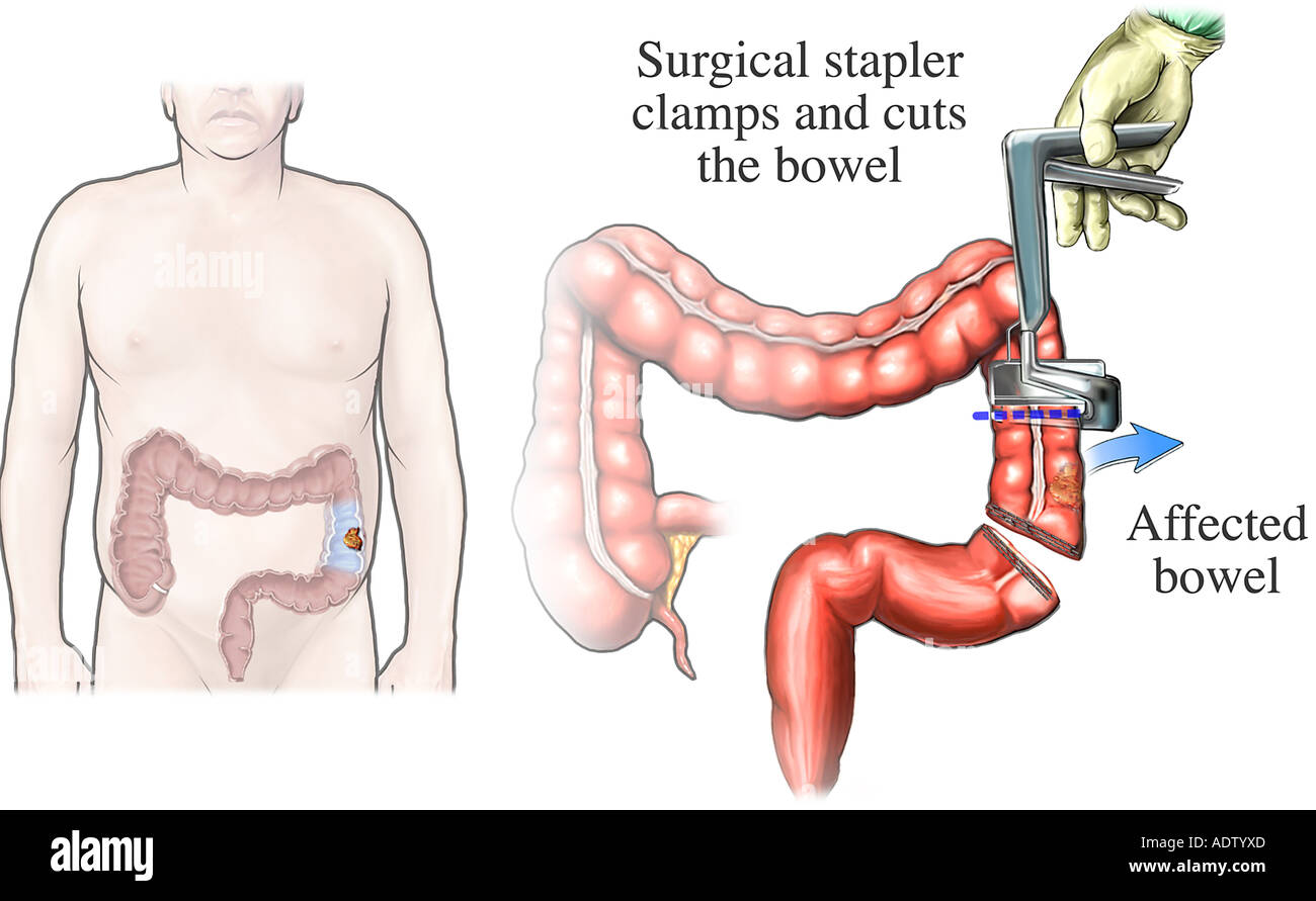 Bowel resection hires stock photography and images Alamy