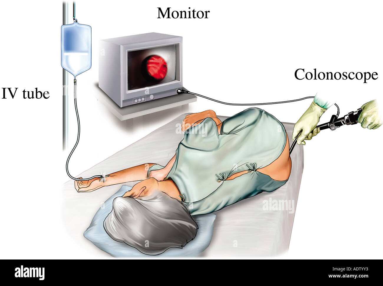 Patient Colon Exam High Resolution Stock Photography and Images Alamy
