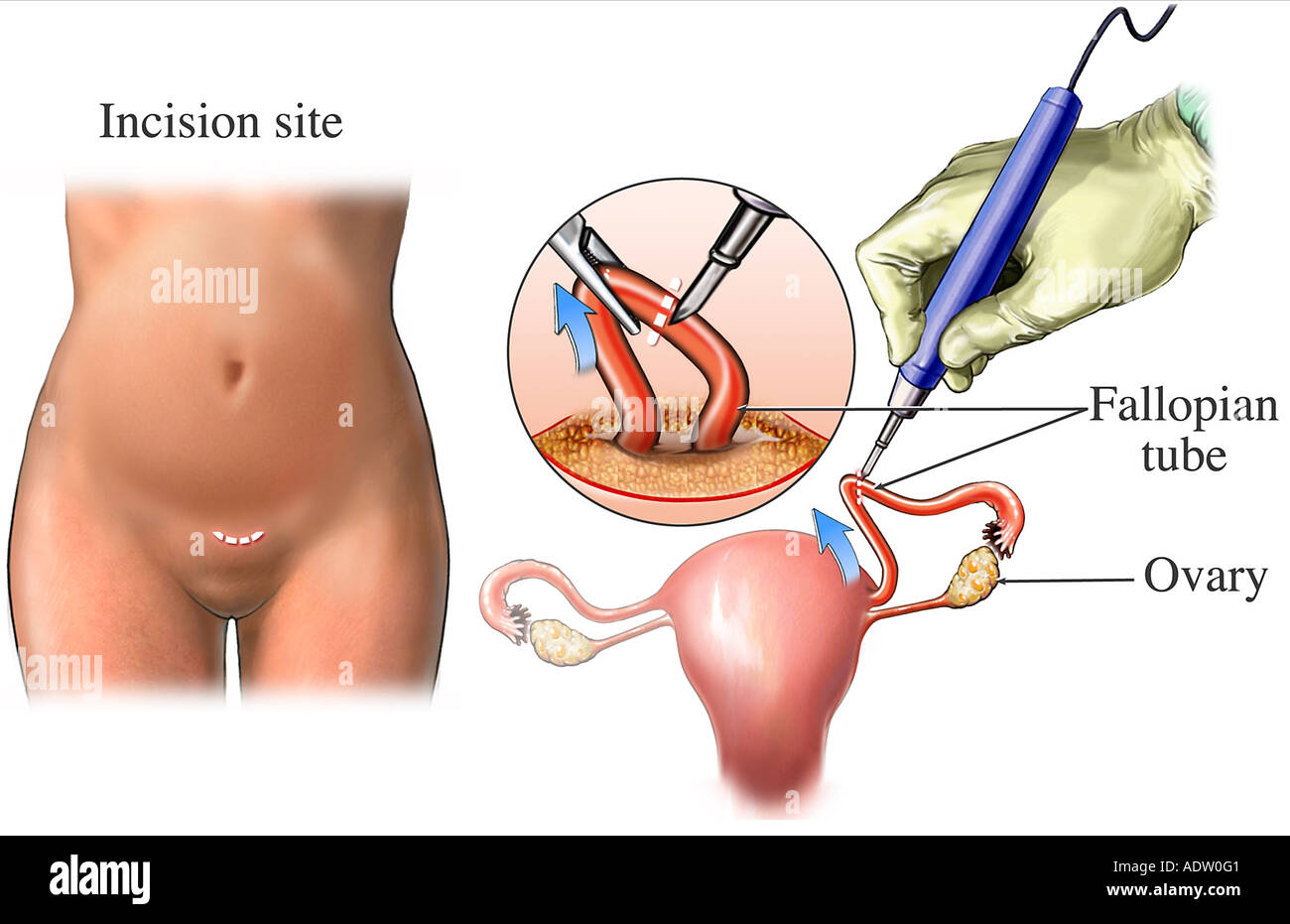 Tubal ligation hi-res stock photography and images - Alamy