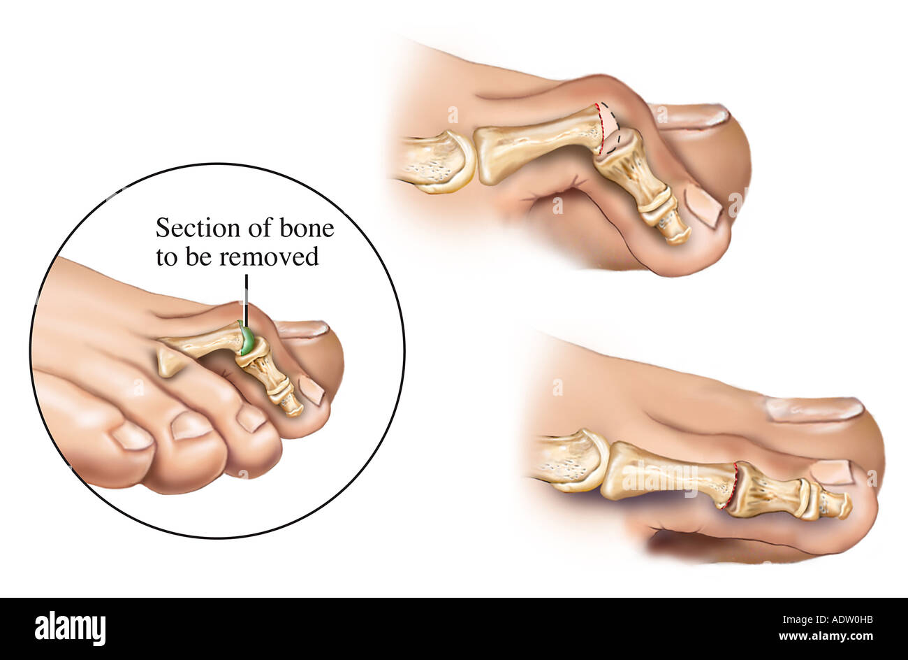Hammer Toe Surgical Repair Stock Photo 7711002 Alamy