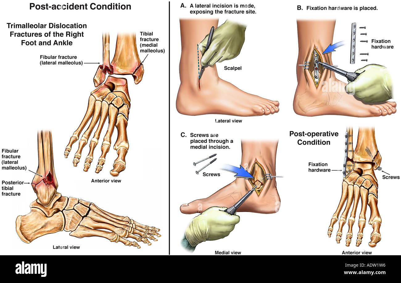 icd 10 lateral malleolus fracture