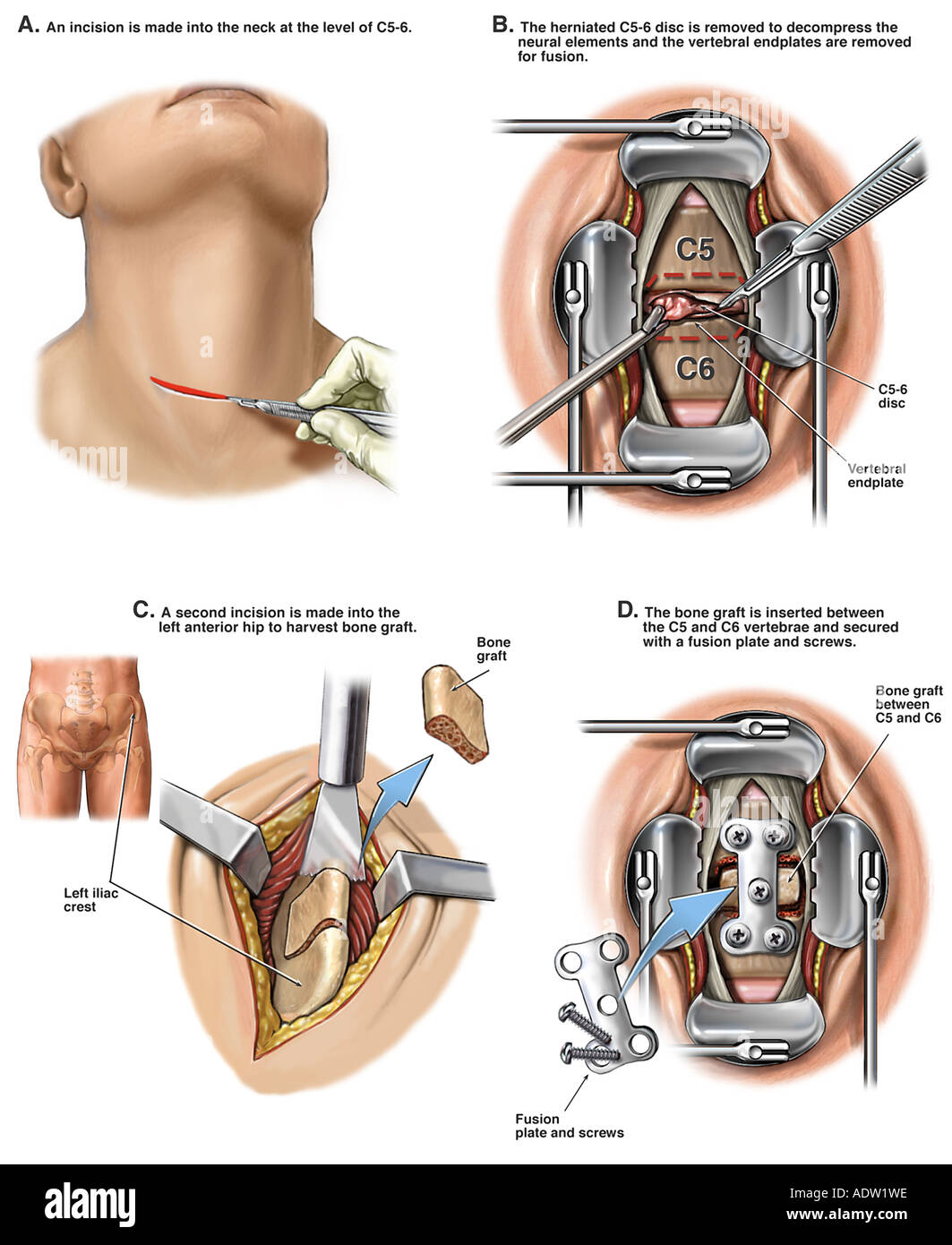 Proposed C5-6 Anterior Cervical Discectomy and Fusion Stock Photo