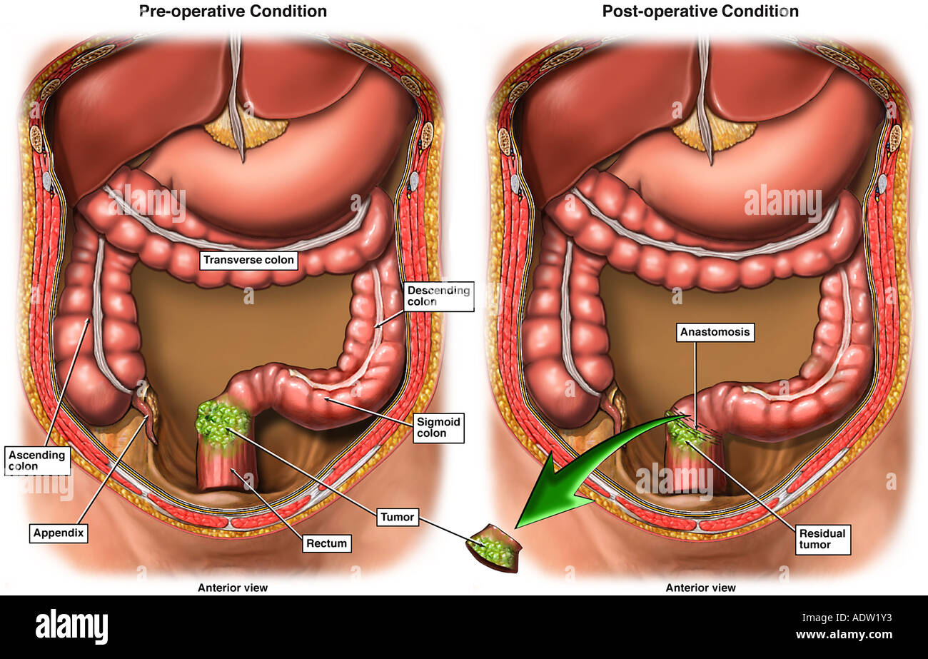 Surgery for Colon and Rectal Cancer Stock Photo Alamy