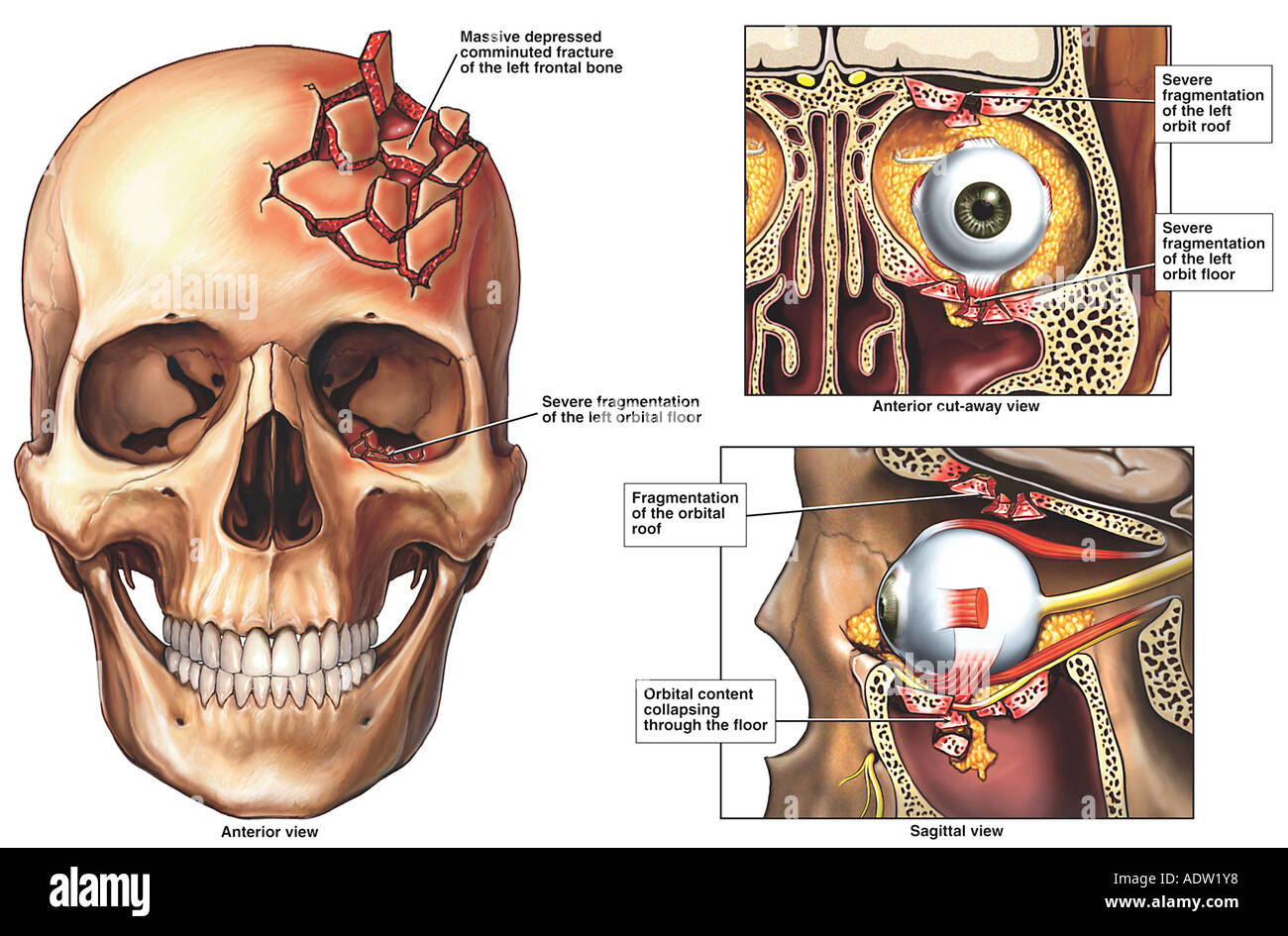 Blowout Fracture Of The Orbital Floor Ct Of The Midface Frontal View Bone Window Orbital O Floor Fr In 2020 Rectus Muscle This Or That Questions Maxillary Sinus